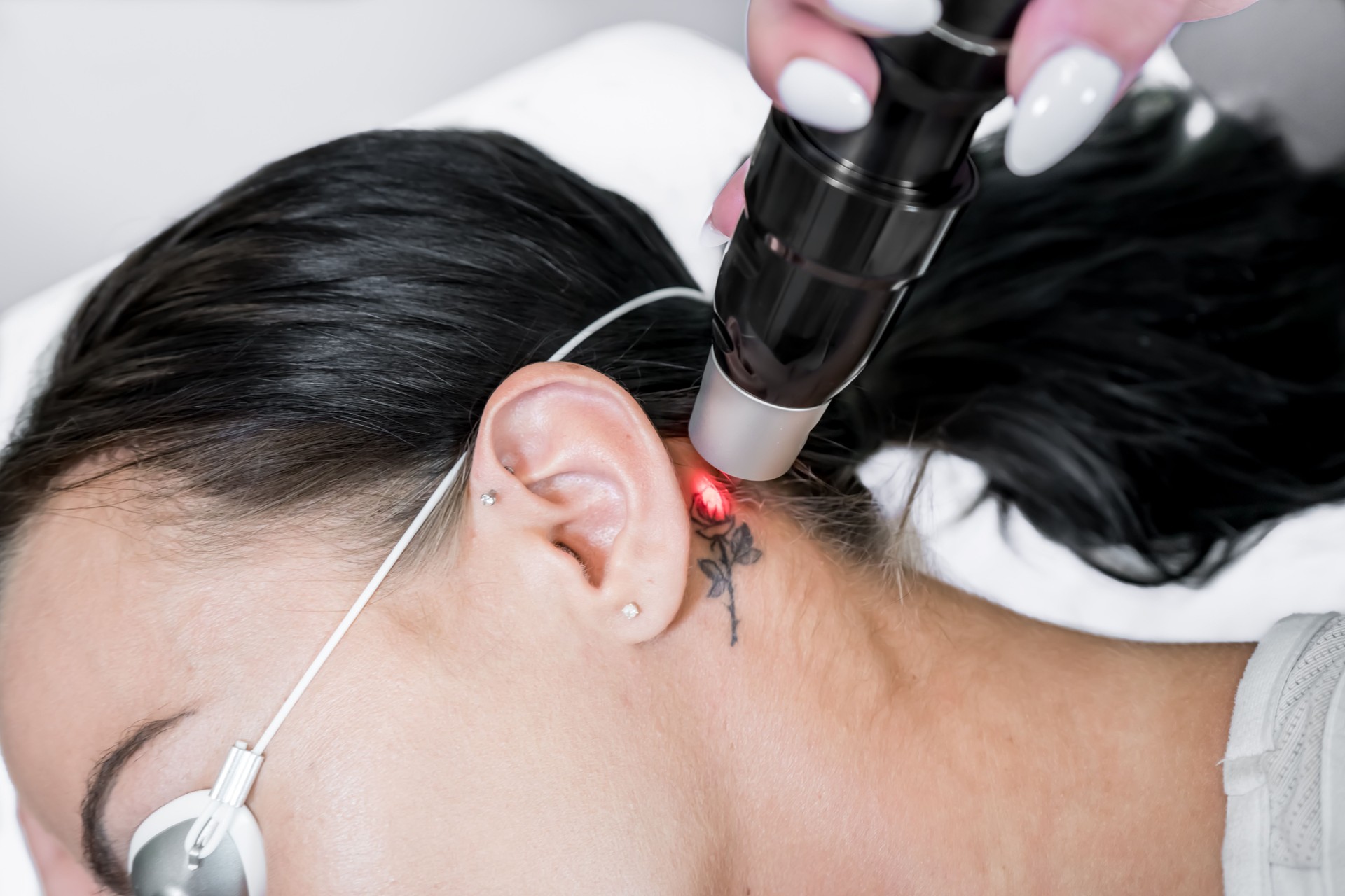 Laser tattoo removal treatment session on patient, using picosecond technology, to break down tattoo ink into smaller particles. At a beauty and skincare clinic for aesthetic lasers.